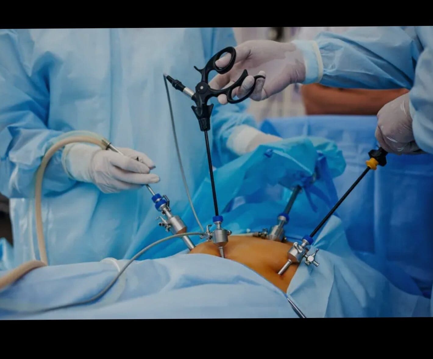 Laparoscopic Surgeries