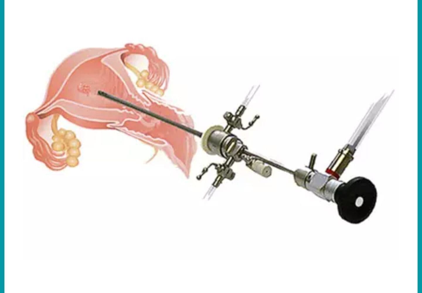 Hysteroscopic Surgeries